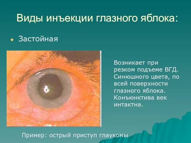 Виды инъекции глазного яблока: Застойная Возникает при резком подъеме ВГД.