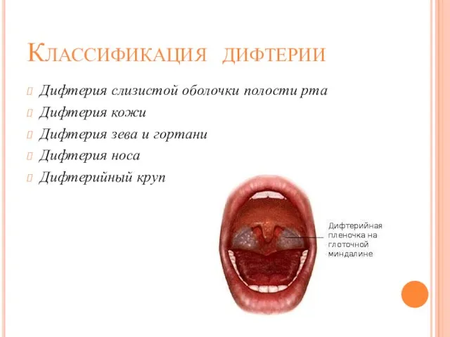 Классификация дифтерии Дифтерия слизистой оболочки полости рта Дифтерия кожи Дифтерия