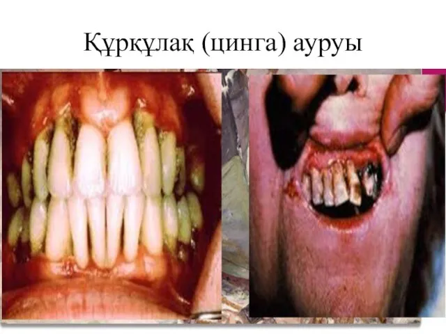 Құрқұлақ (цинга) ауруы