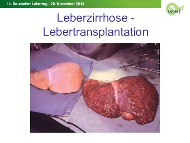 Leberzirrhose - Lebertransplantation