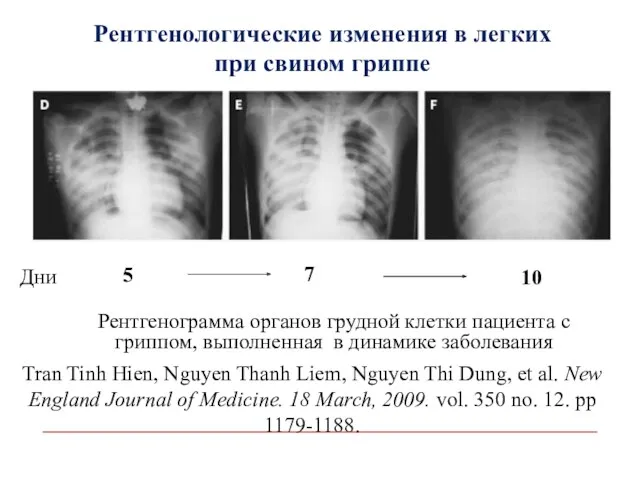 Рентгенологические изменения в легких при свином гриппе Рентгенограмма органов грудной