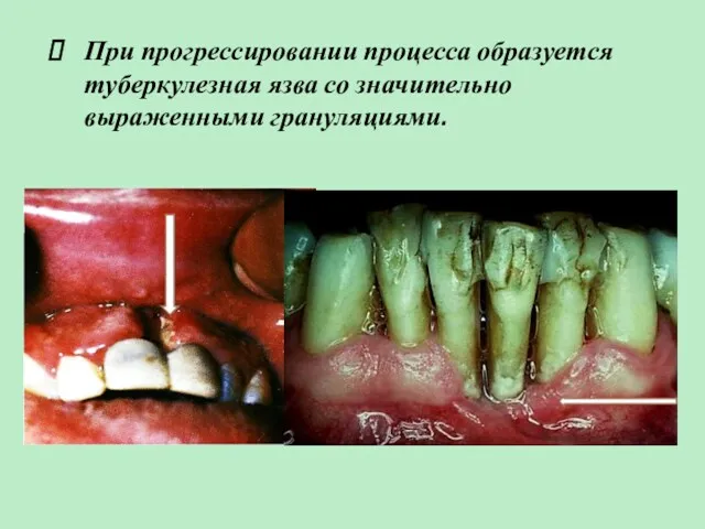 При прогрессировании процесса образуется туберкулезная язва со значительно выраженными грануляциями.