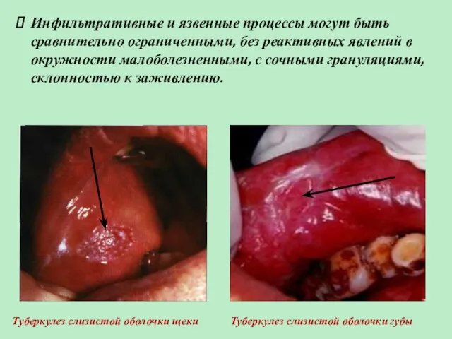 Инфильтративные и язвенные процессы могут быть сравнительно ограниченными, без реактивных