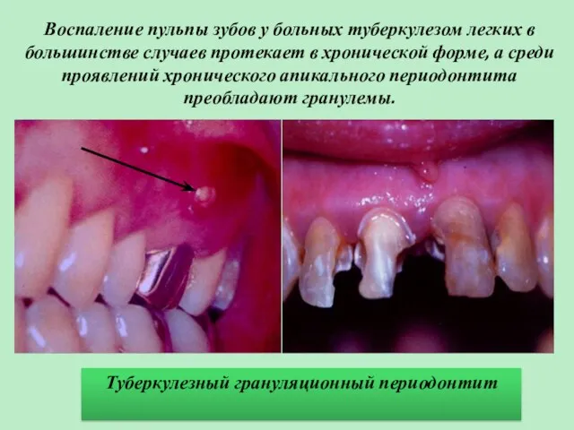 Воспаление пульпы зубов у больных туберкулезом легких в большинстве случаев