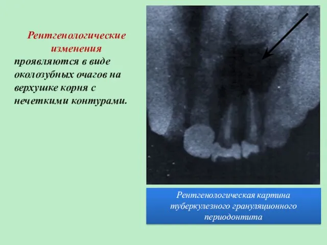 Рентгенологическая картина туберкулезного грануляционного периодонтита Рентгенологические изменения проявляются в виде