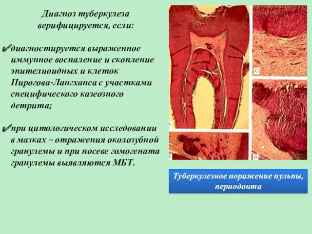 Туберкулезное поражение пульпы, периодонта Диагноз туберкулеза верифицируется, если: диагностируется выраженное