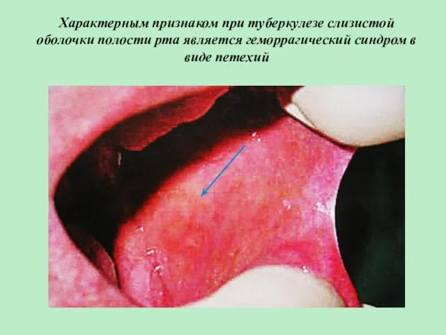 Характерным признаком при туберкулезе слизистой оболочки полости рта является геморрагический синдром в виде петехий