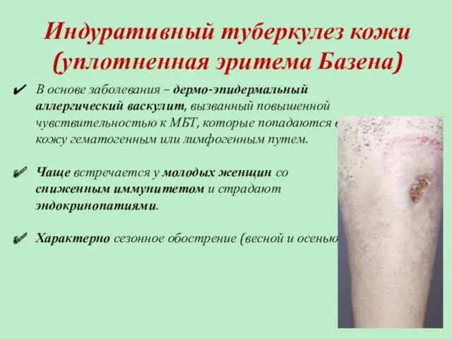Индуративный туберкулез кожи (уплотненная эритема Базена) В основе заболевания –