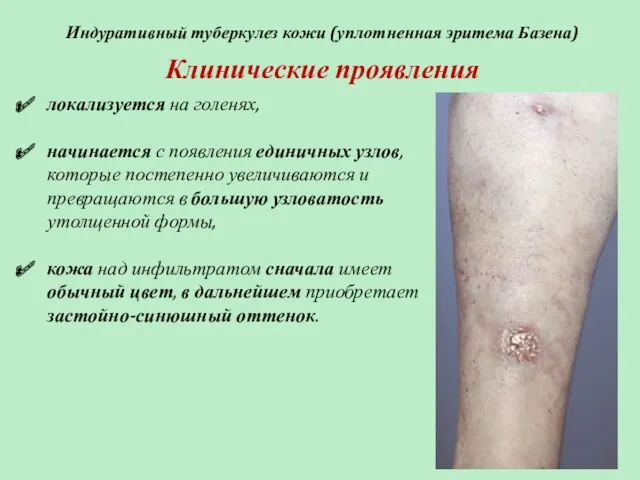 Индуративный туберкулез кожи (уплотненная эритема Базена) Клинические проявления локализуется на