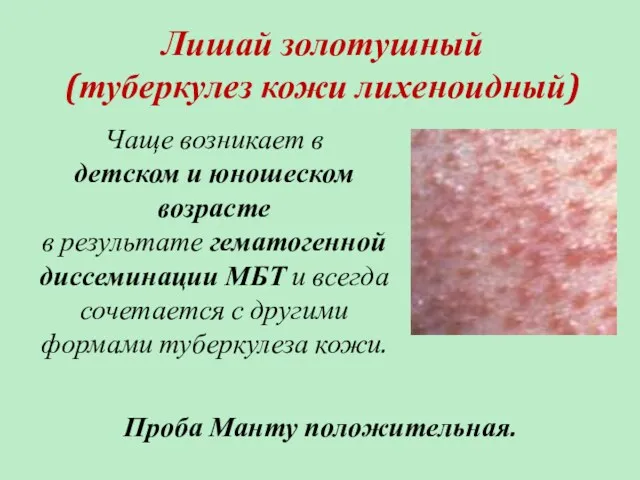 Лишай золотушный (туберкулез кожи лихеноидный) Чаще возникает в детском и