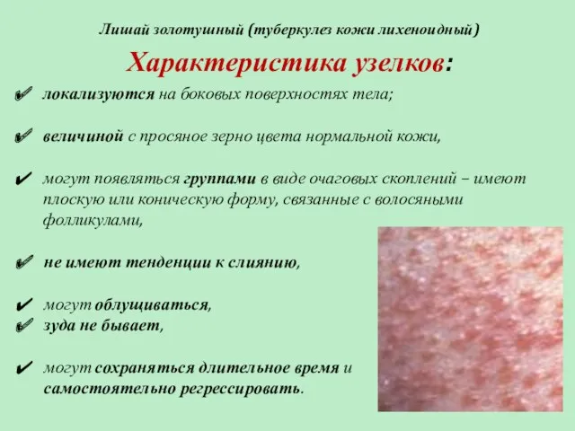 Лишай золотушный (туберкулез кожи лихеноидный) Характеристика узелков: локализуются на боковых