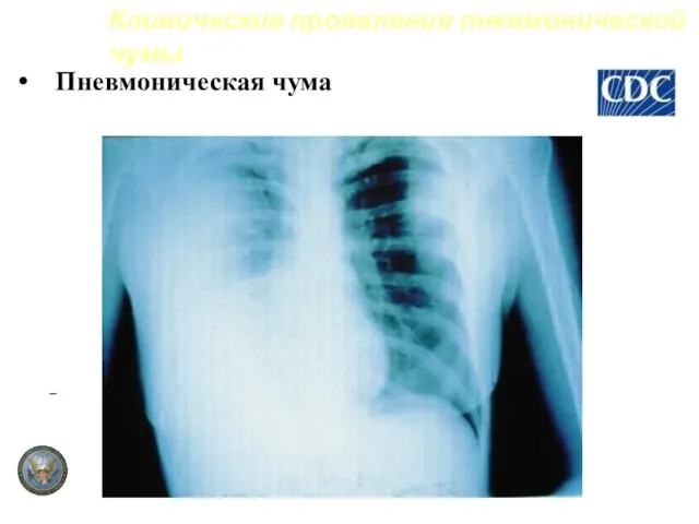 Пневмоническая чума Клинические проявления пневмонической чумы