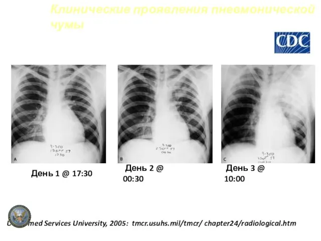 Клинические проявления пневмонической чумы День 1 @ 17:30 День 2