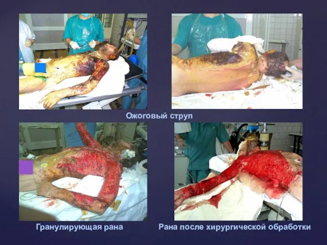 Ожоговый струп Гранулирующая рана Рана после хирургической обработки