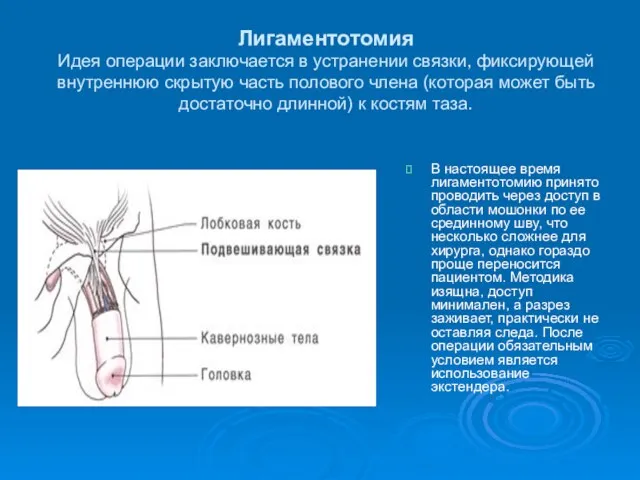 Лигаментотомия Идея операции заключается в устранении связки, фиксирующей внутреннюю скрытую