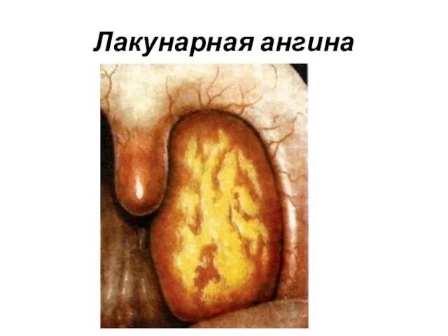 Лакунарная ангина