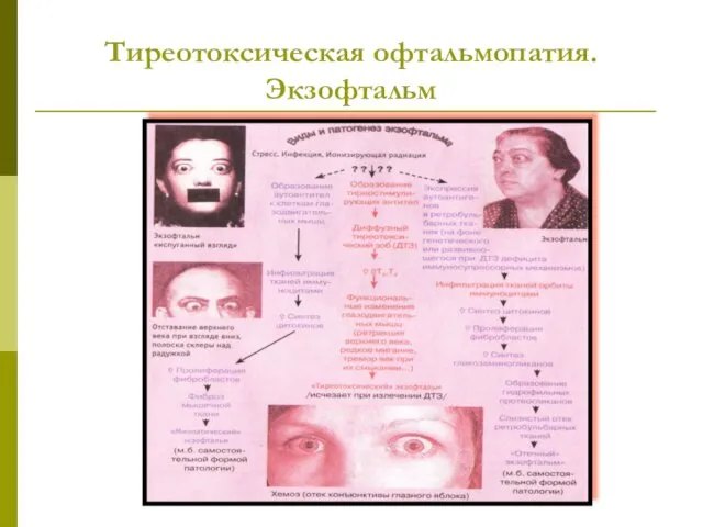 Тиреотоксическая офтальмопатия. Экзофтальм
