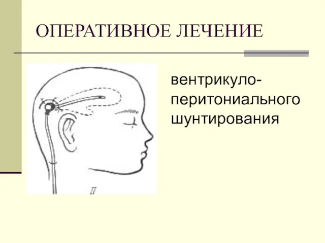 ОПЕРАТИВНОЕ ЛЕЧЕНИЕ вентрикуло- перитониального шунтирования