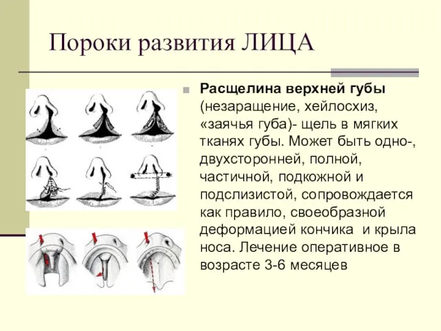 Пороки развития ЛИЦА Расщелина верхней губы (незаращение, хейлосхиз, «заячья губа)-