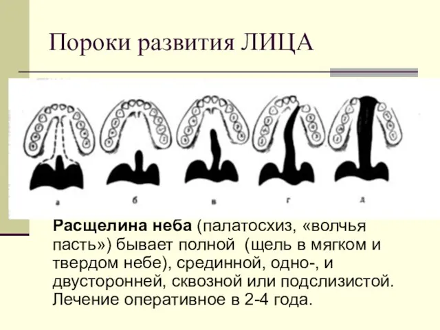 Пороки развития ЛИЦА Расщелина неба (палатосхиз, «волчья пасть») бывает полной