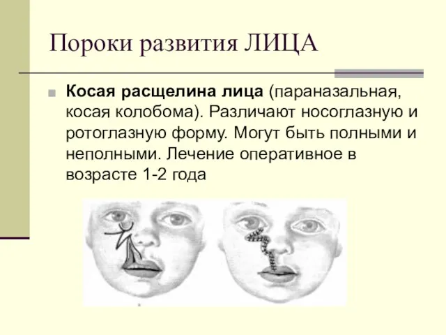 Пороки развития ЛИЦА Косая расщелина лица (параназальная, косая колобома). Различают носоглазную и ротоглазную