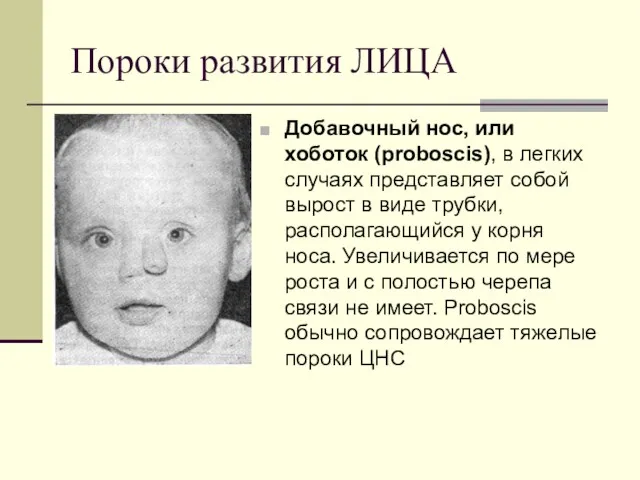 Пороки развития ЛИЦА Добавочный нос, или хоботок (proboscis), в легких случаях представляет собой