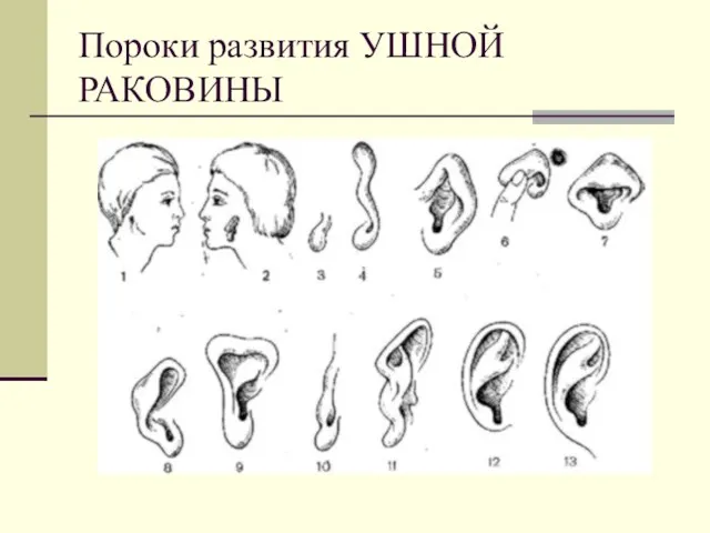 Пороки развития УШНОЙ РАКОВИНЫ