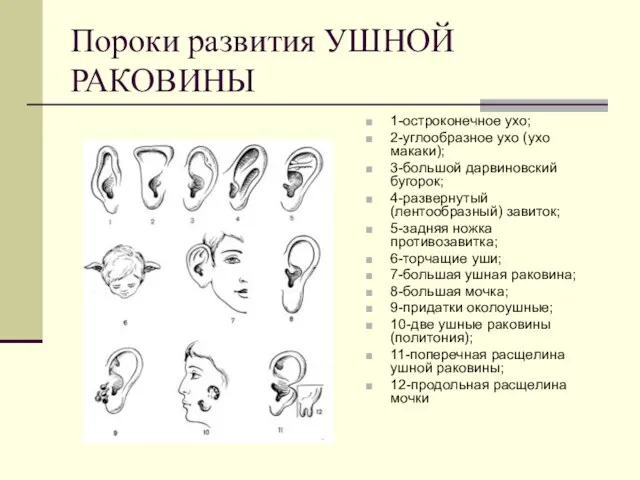 Пороки развития УШНОЙ РАКОВИНЫ 1-остроконечное ухо; 2-углообразное ухо (ухо макаки); 3-большой дарвиновский бугорок;