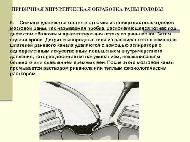 ПЕРВИЧНАЯ ХИРУРГИЧЕСКАЯ ОБРАБОТКА РАНЫ ГОЛОВЫ 6. Сначала удаляются костные отломки из поверхностных отделов