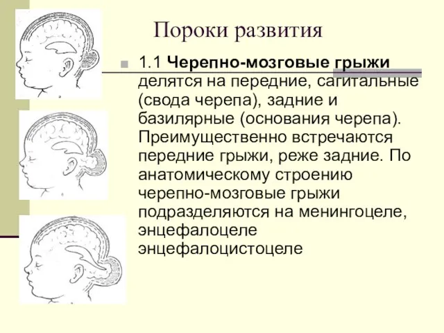 Пороки развития 1.1 Черепно-мозговые грыжи делятся на передние, сагитальные (свода черепа), задние и