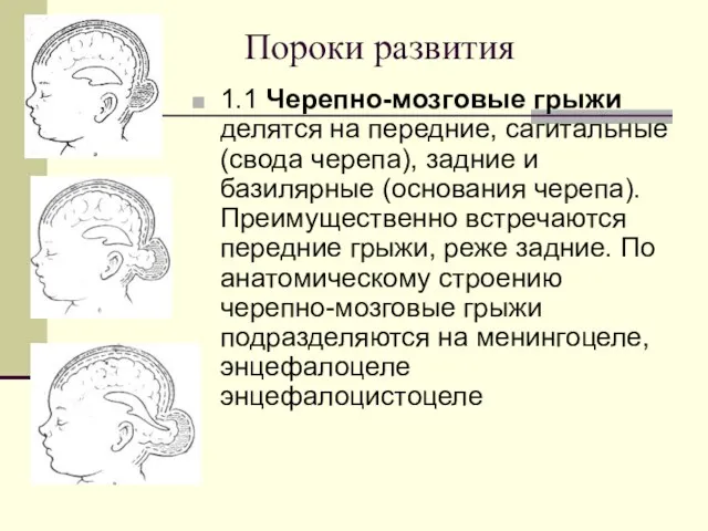 Пороки развития 1.1 Черепно-мозговые грыжи делятся на передние, сагитальные (свода