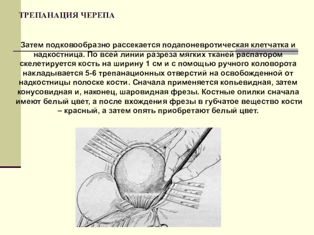 ТРЕПАНАЦИЯ ЧЕРЕПА Затем подковообразно рассекается подапоневротическая клетчатка и надкостница. По