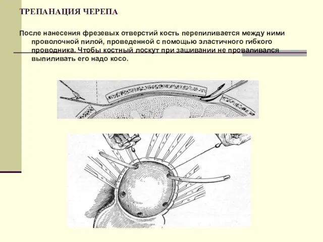 ТРЕПАНАЦИЯ ЧЕРЕПА После нанесения фрезевых отверстий кость перепиливается между ними