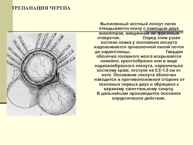 ТРЕПАНАЦИЯ ЧЕРЕПА Выпиленный костный лоскут легко откидывается книзу с помощью двух элеваторов, введенных