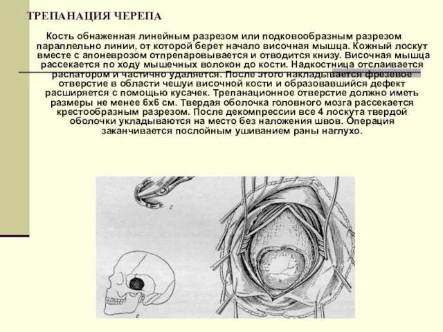 ТРЕПАНАЦИЯ ЧЕРЕПА Кость обнаженная линейным разрезом или подковообразным разрезом параллельно линии, от которой