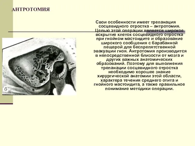 АНТРОТОМИЯ Свои особенности имеет трепанация сосцевидного отростка – антротомия. Целью этой операции является