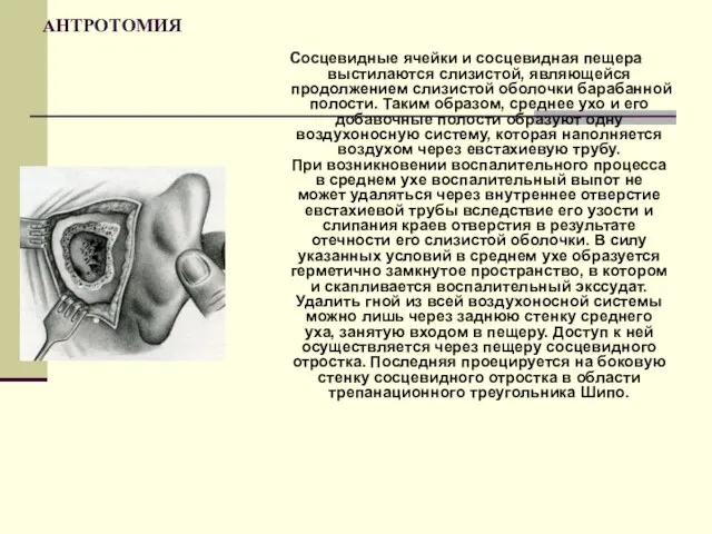 АНТРОТОМИЯ Сосцевидные ячейки и сосцевидная пещера выстилаются слизистой, являющейся продолжением слизистой оболочки барабанной