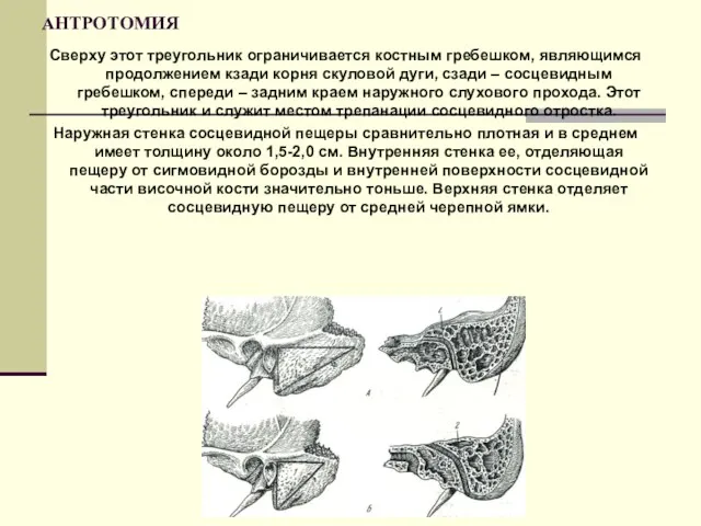 АНТРОТОМИЯ Сверху этот треугольник ограничивается костным гребешком, являющимся продолжением кзади корня скуловой дуги,