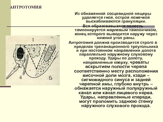 АНТРОТОМИЯ Из обнаженной сосцевидной пещеры удаляется гной, острой ложечкой выскабливаются грануляции. Вся образовавшаяся