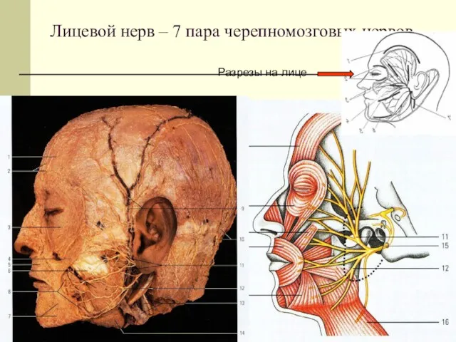 Лицевой нерв – 7 пара черепномозговых нервов Разрезы на лице