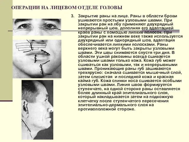 ОПЕРАЦИИ НА ЛИЦЕВОМ ОТДЕЛЕ ГОЛОВЫ 3. Закрытие раны на лице. Раны в области