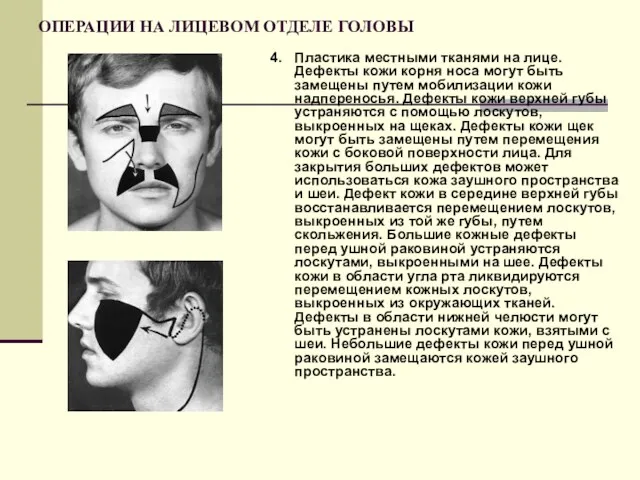 ОПЕРАЦИИ НА ЛИЦЕВОМ ОТДЕЛЕ ГОЛОВЫ 4. Пластика местными тканями на лице. Дефекты кожи