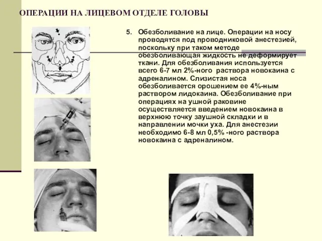 ОПЕРАЦИИ НА ЛИЦЕВОМ ОТДЕЛЕ ГОЛОВЫ 5. Обезболивание на лице. Операции на носу проводятся