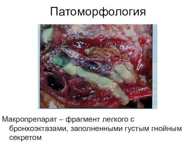 Патоморфология Макропрепарат – фрагмент легкого с бронхоэктазами, заполненными густым гнойным секретом