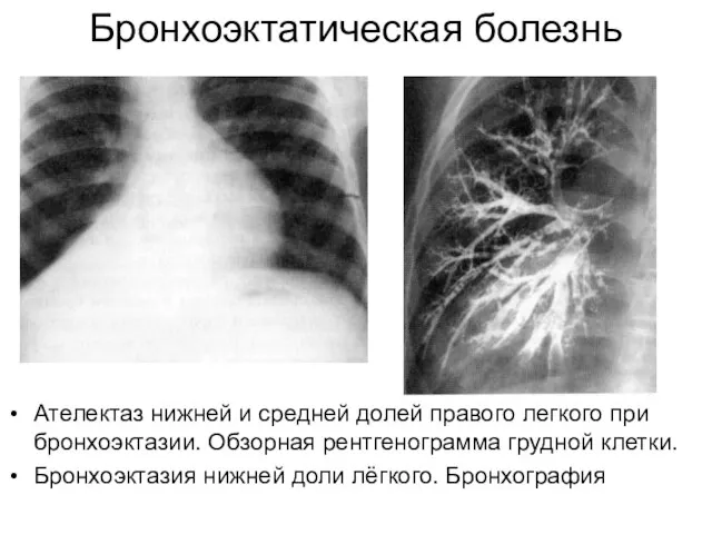 Бронхоэктатическая болезнь Ателектаз нижней и средней долей правого легкого при