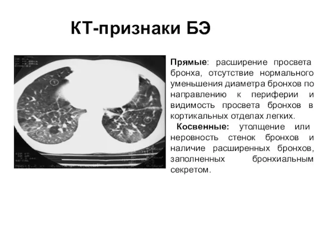 Прямые: расширение просвета бронха, отсутствие нормального уменьшения диаметра бронхов по