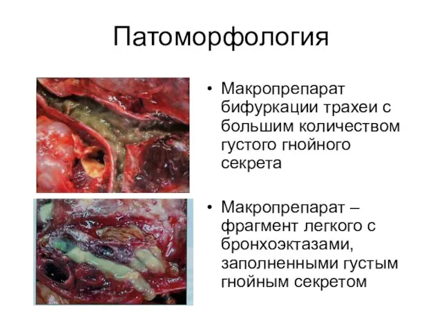 Патоморфология Макропрепарат бифуркации трахеи с большим количеством густого гнойного секрета