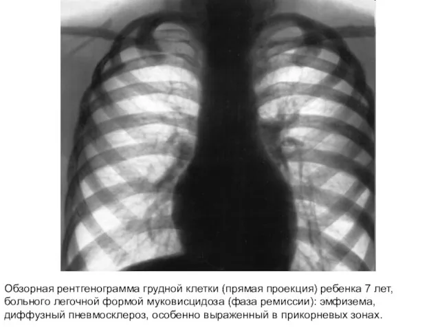 Обзорная рентгенограмма грудной клетки (прямая проекция) ребенка 7 лет, больного