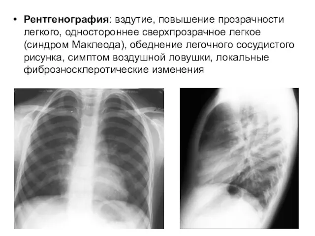 Рентгенография: вздутие, повышение прозрачности легкого, одностороннее сверхпрозрачное легкое (синдром Маклеода),