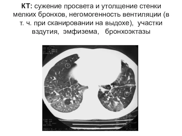 КТ: сужение просвета и утолщение стенки мелких бронхов, негомогенность вентиляции